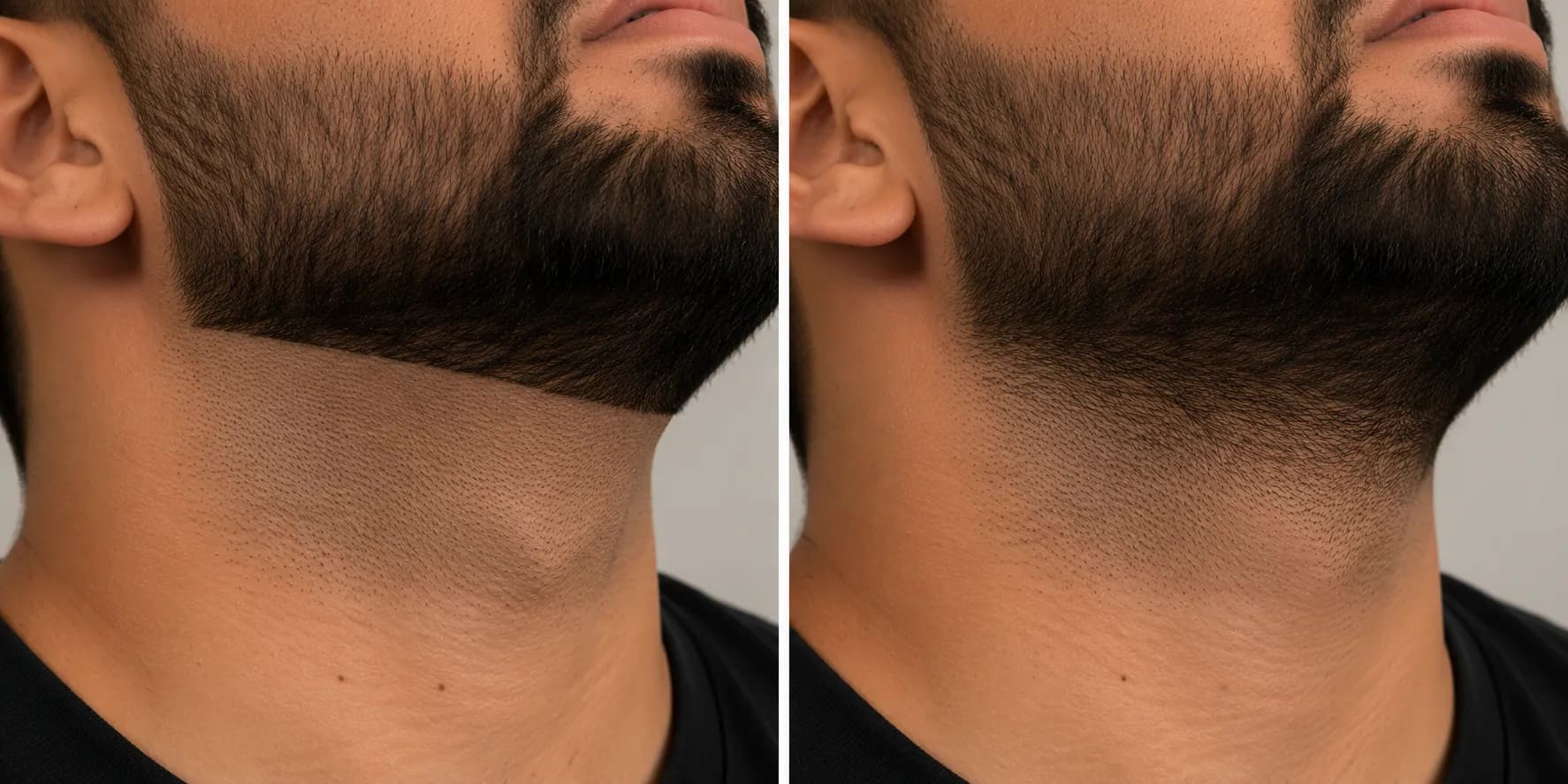 Before-and-after close-up of a beard neckline showing a harsh hard line on one side and a soft faded transition on the other, demonstrating a cleaner, natural-looking beard taper.