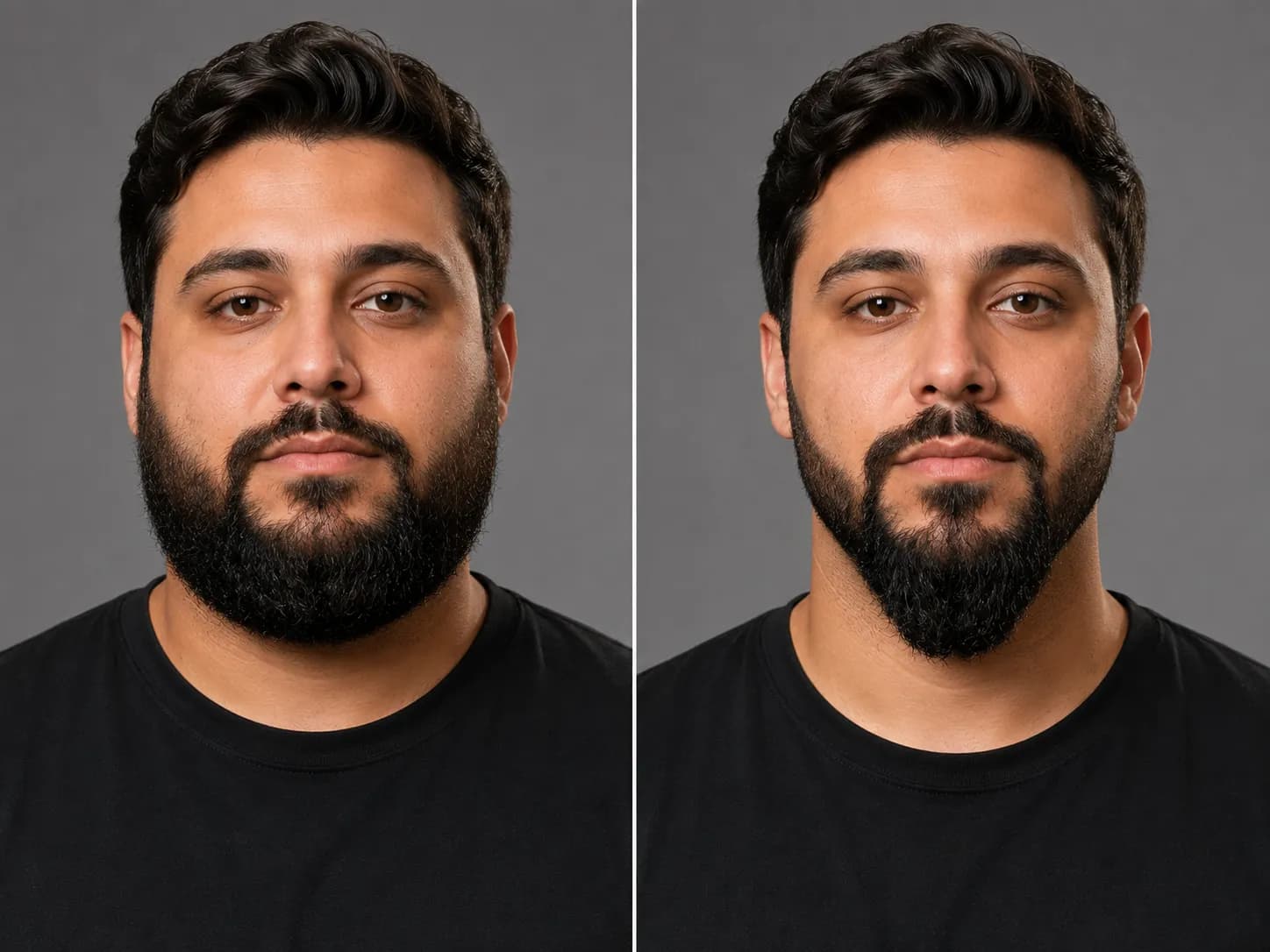 Before-and-after comparison of a round-faced man with a beard, showing shorter tapered cheeks and a longer squared chin that creates a slimmer, more defined jawline.